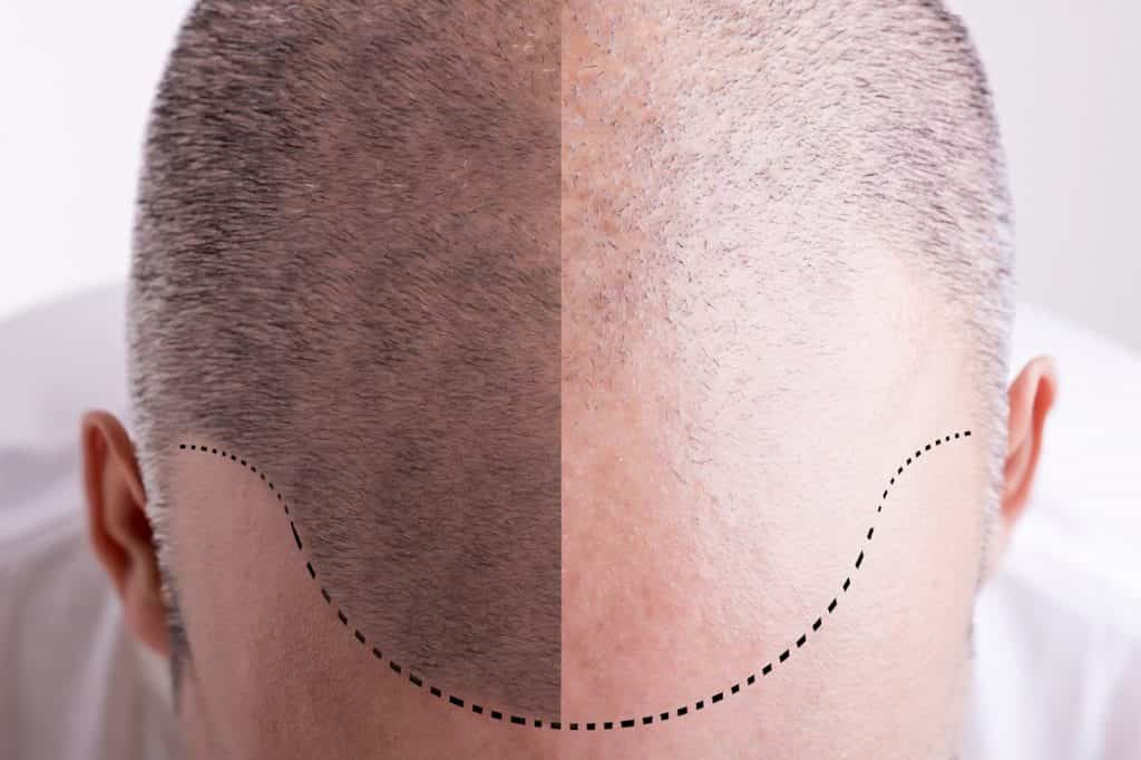 Haaransatz vor und nach einer Haartransplantation