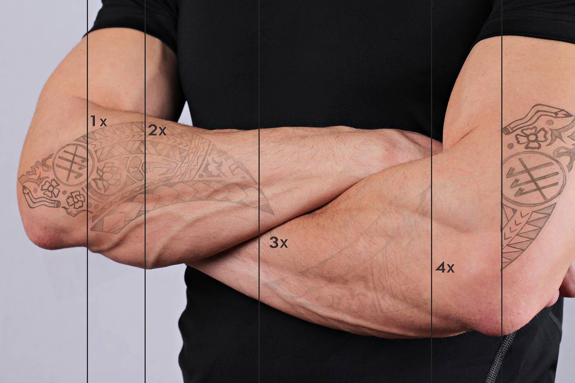 Tattooentfernung per Laser