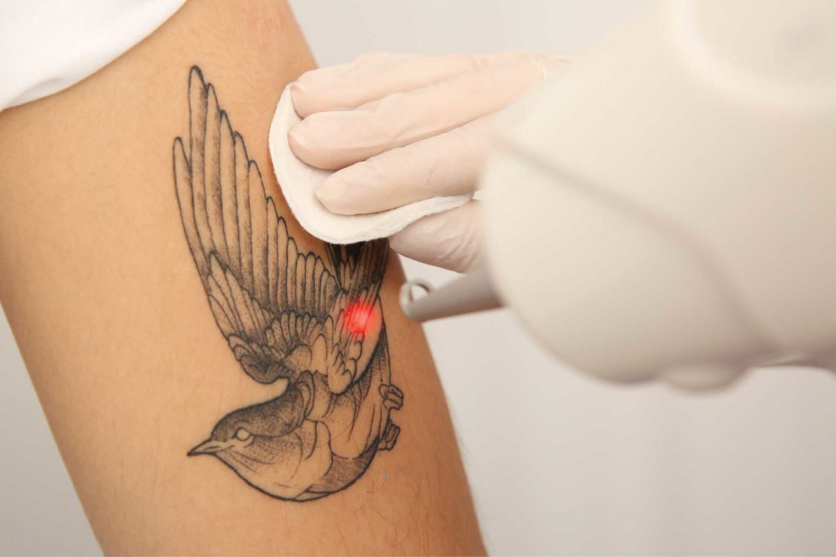 Tattooentfernung